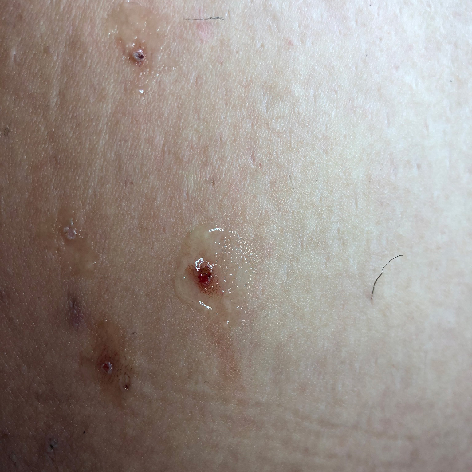 Nachher Bild einer Elektroepilation.