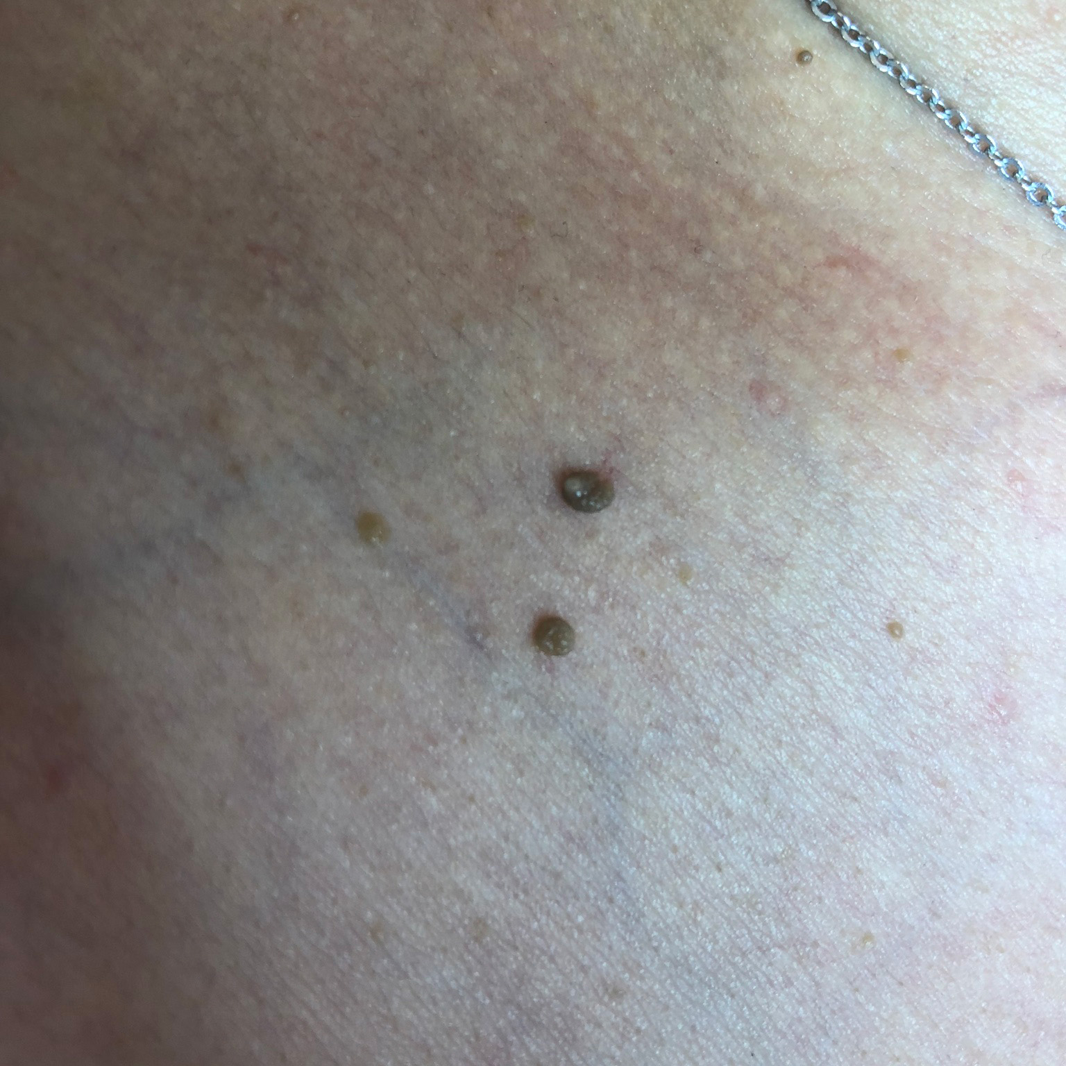 Vorher Bild einer Elektroepilation am Hals.