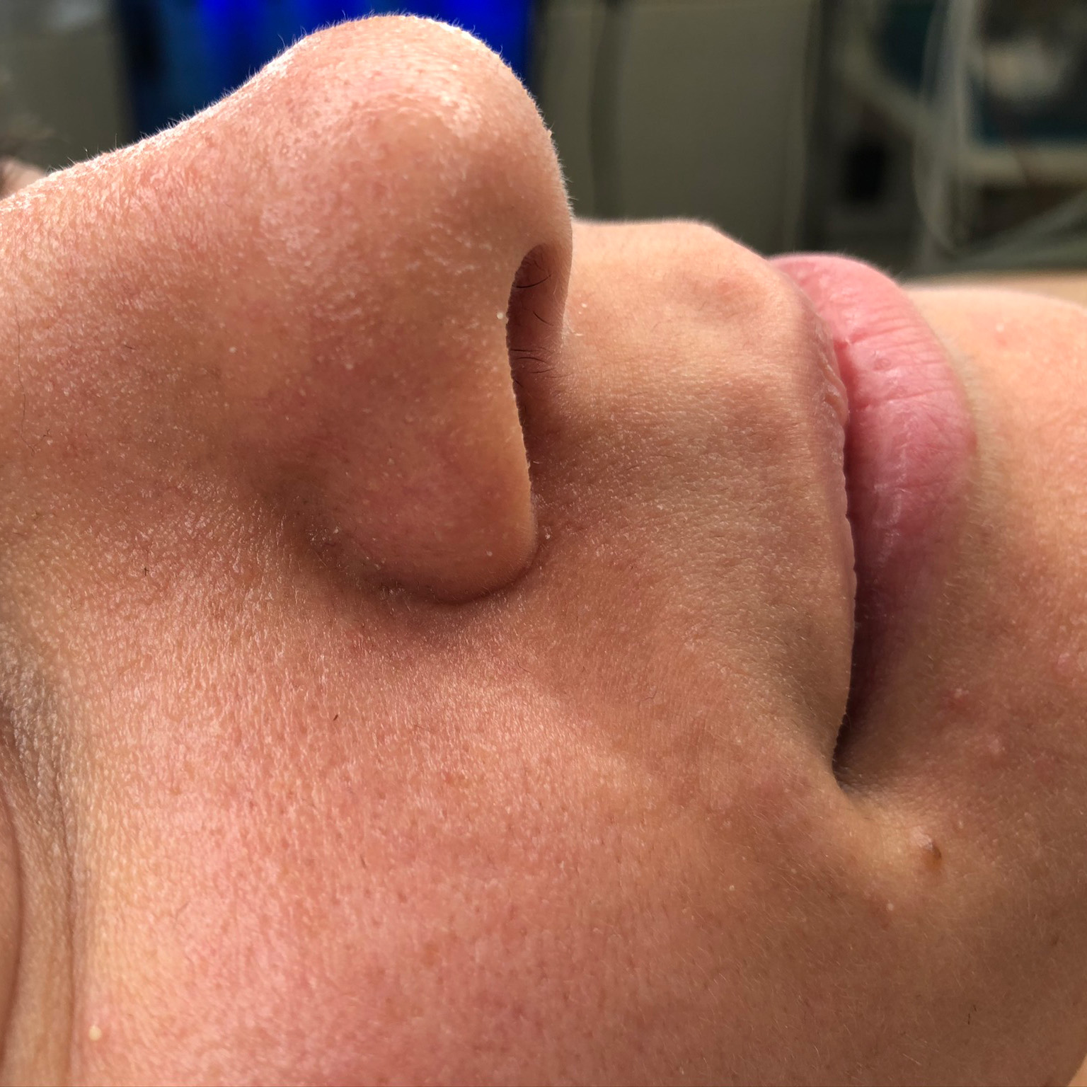 Nachher Aufnahme einer Frau und ihrem Gesicht. Sie lächelt und hat ein ebenmässigeres Hautbild dank Hydrafacial.
