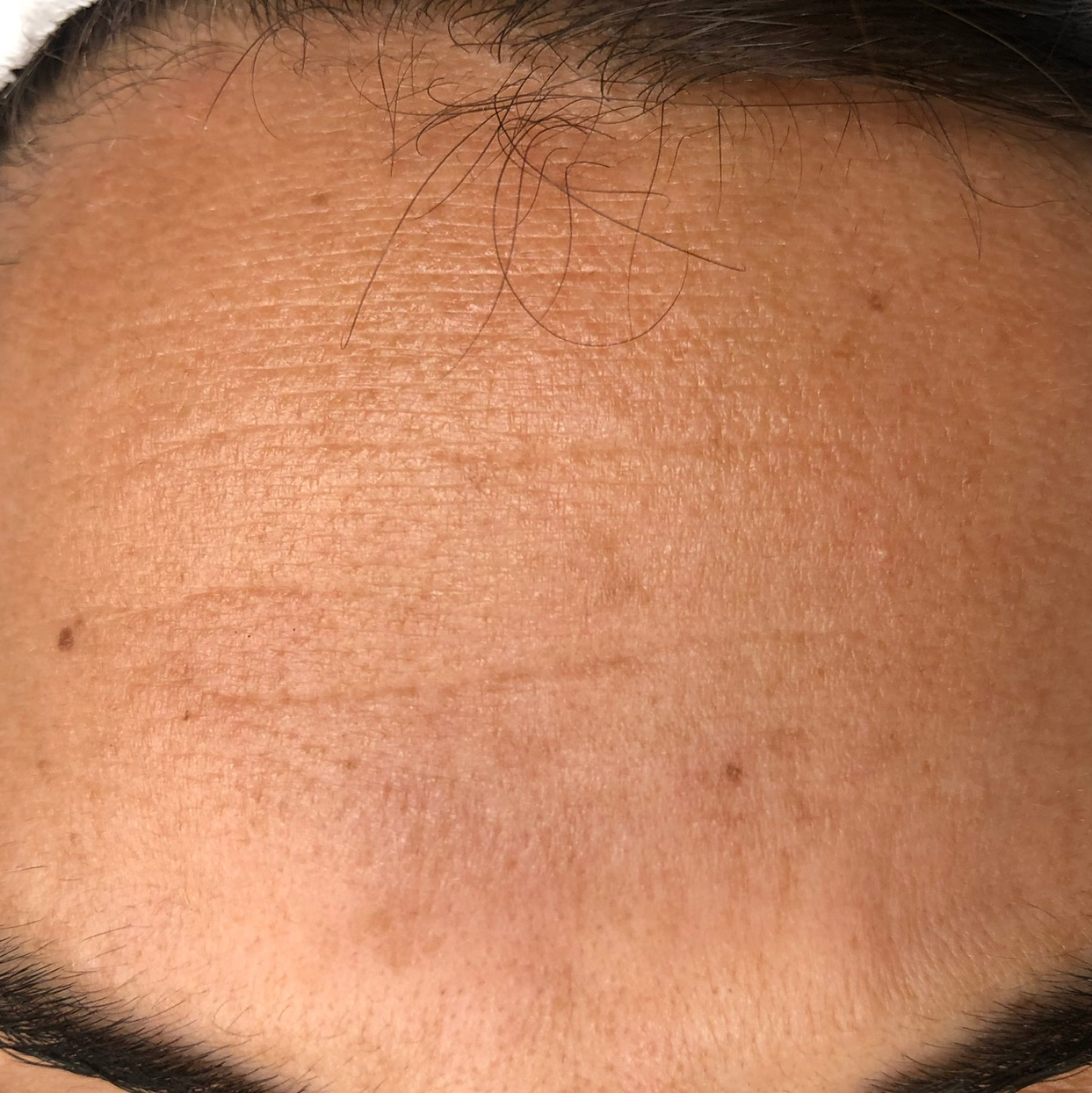 Nachher-Bild von einer Frau und ihrer Stirn nach der Anti Aging-Behandlungen – sichtbare Verbesserung der Hautstruktur, die Falten sind feiner.