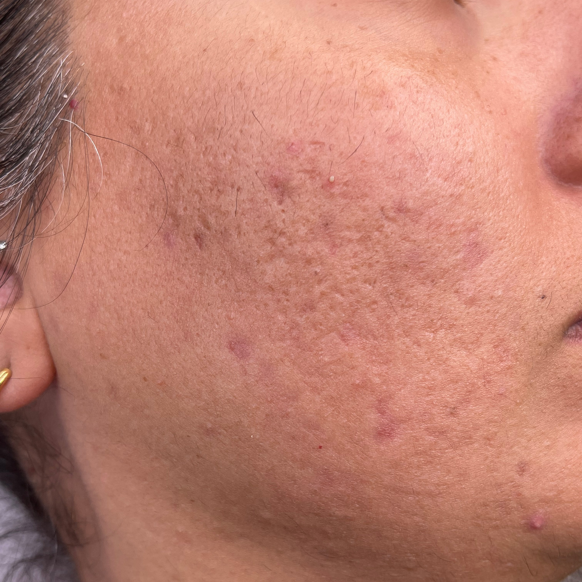 Nachher-Bild von einer Frau und ihrer Wange nach der Anti Aging-Behandlungen – sichtbare Verbesserung der Hautstruktur, Akne ist weniger.